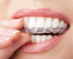 What is the Cost of Clear Braces?