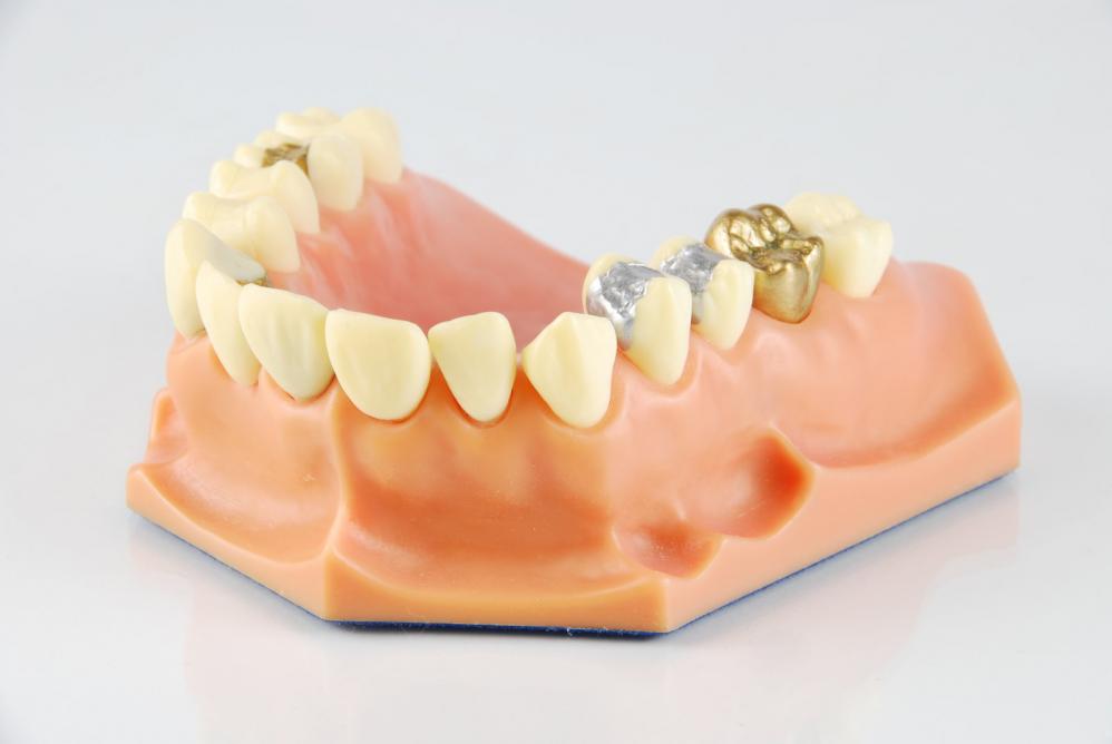 types of dental fillings