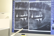 x-ray image of patient's mouth on screen