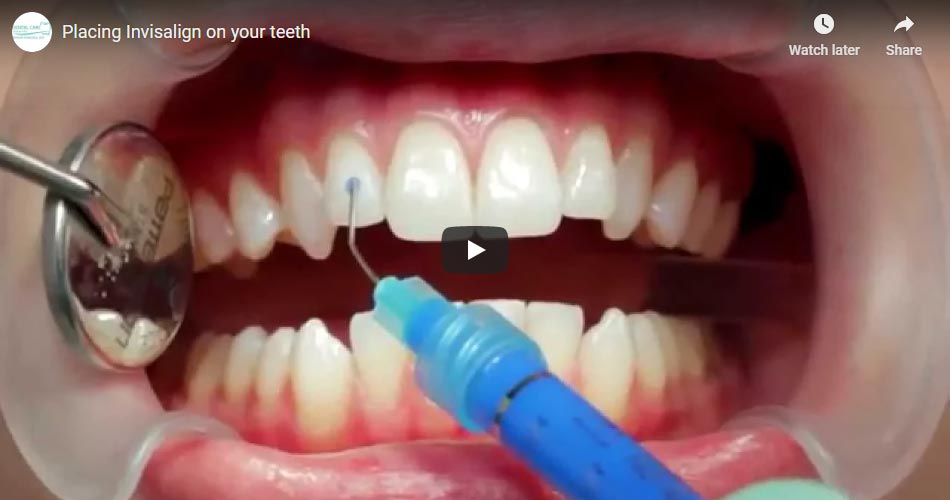 video depicting the placement of invisalign on patient's teeth