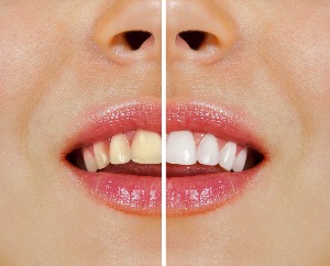 smiling patient cross-section, left side shows teeth before tooth whitening treatment, right side shows white teeth after treatment