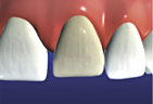 graphic depicting tooth with veneer