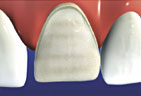 graphic depicting tooth with veneer being applied