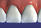 graphic depicting tooth before veneer applied
