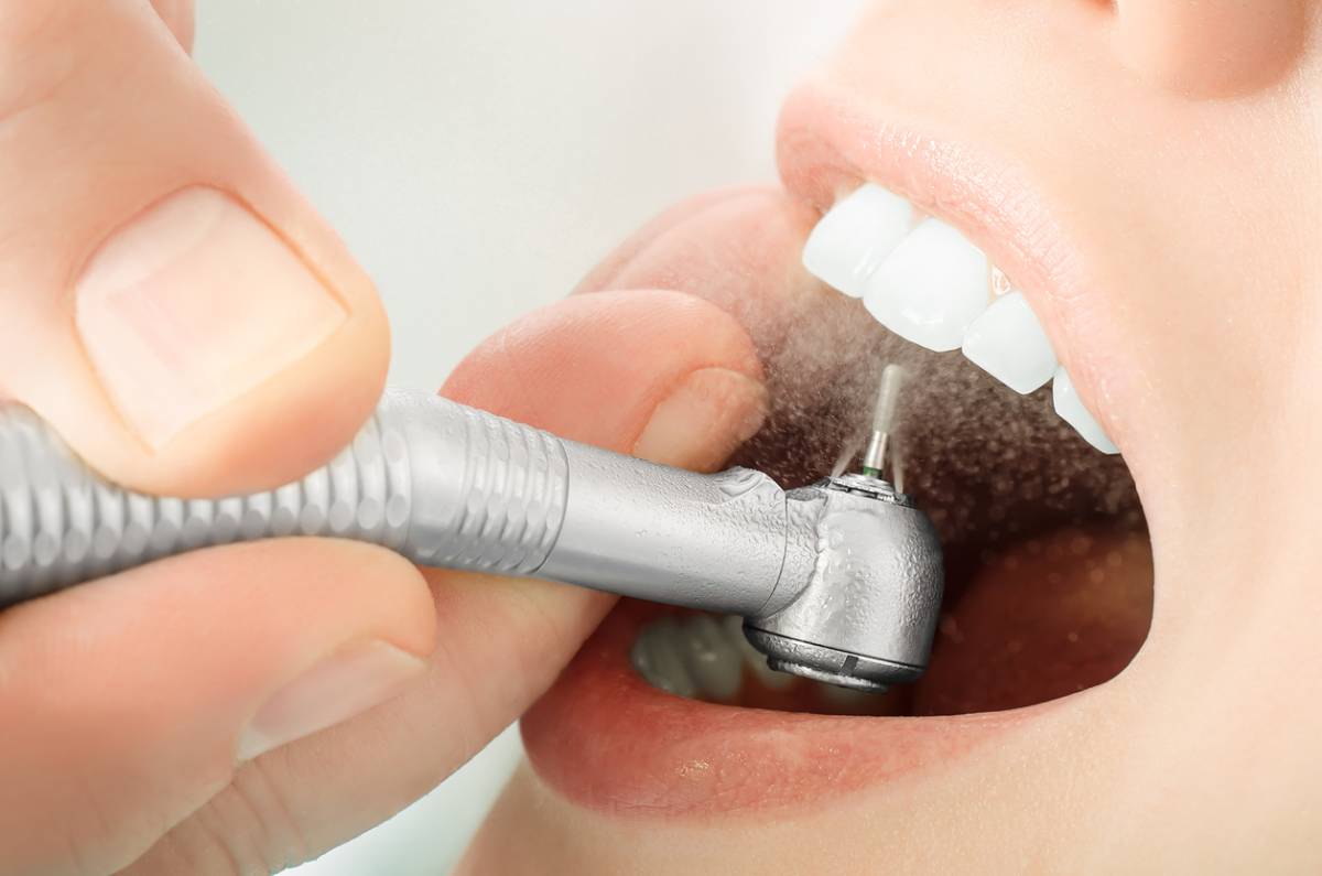Concept image of patient wondering does teeth cleaning remove stains