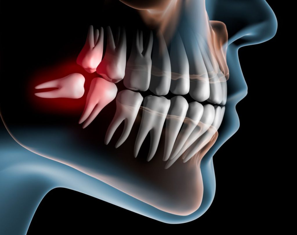 Causes of Wisdom Teeth Pain Dental Care of Chino Hills Blog