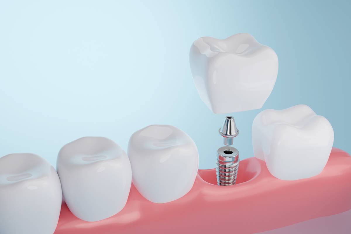 concept of can dental implants be removed