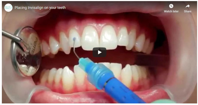 Placing invisalign on your teeth video
