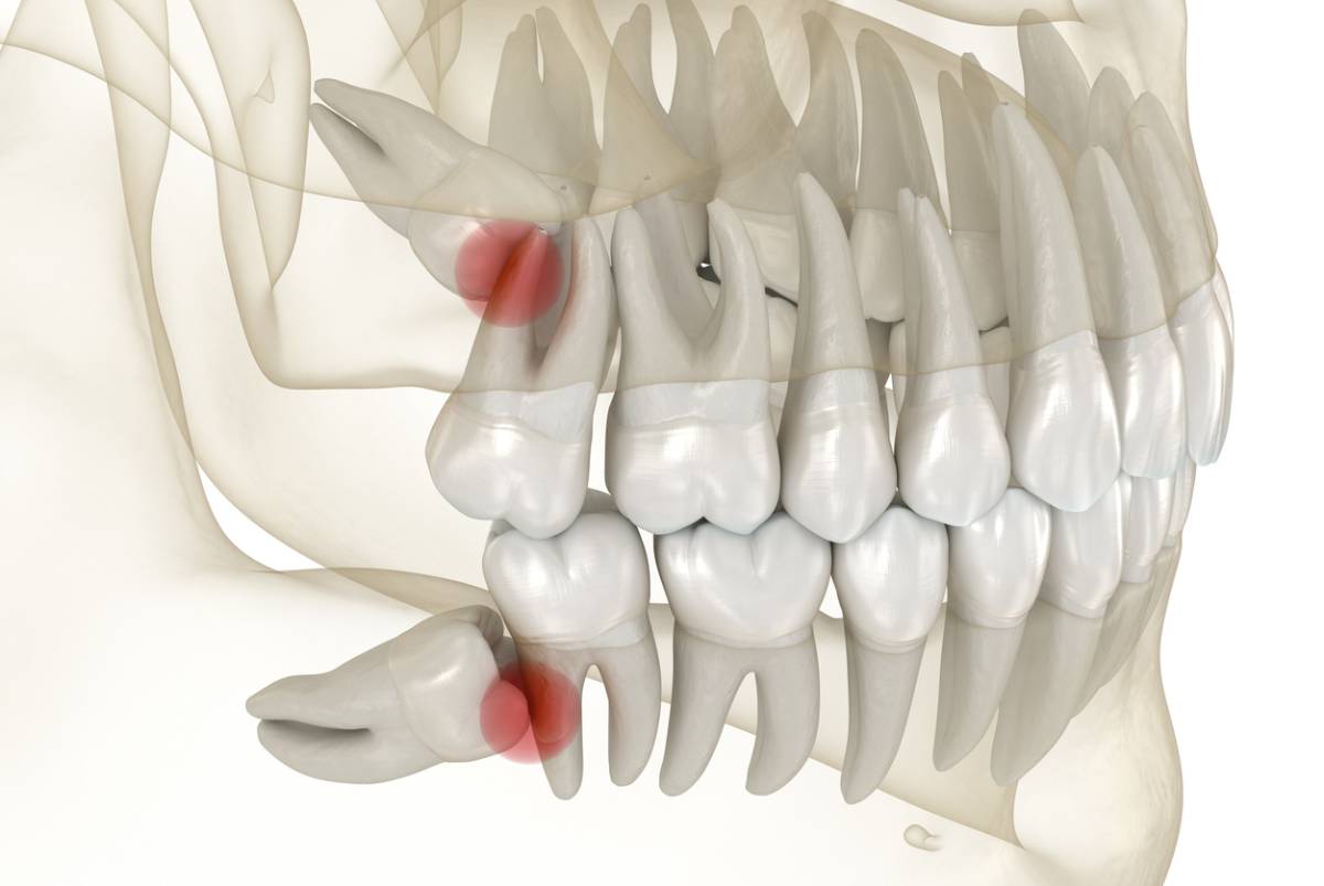 featured image for signs of impacted wisdom teeth