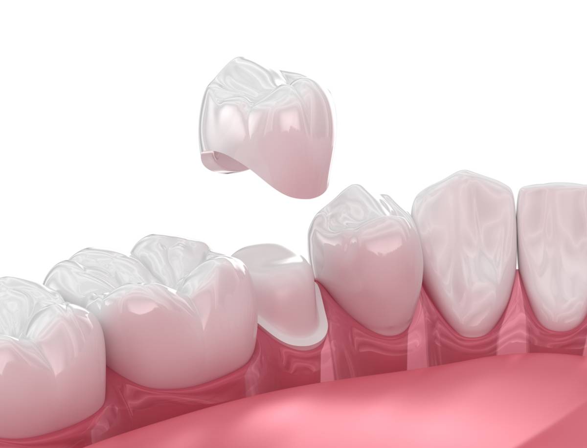 featured image for signs you need to replace dental crowns