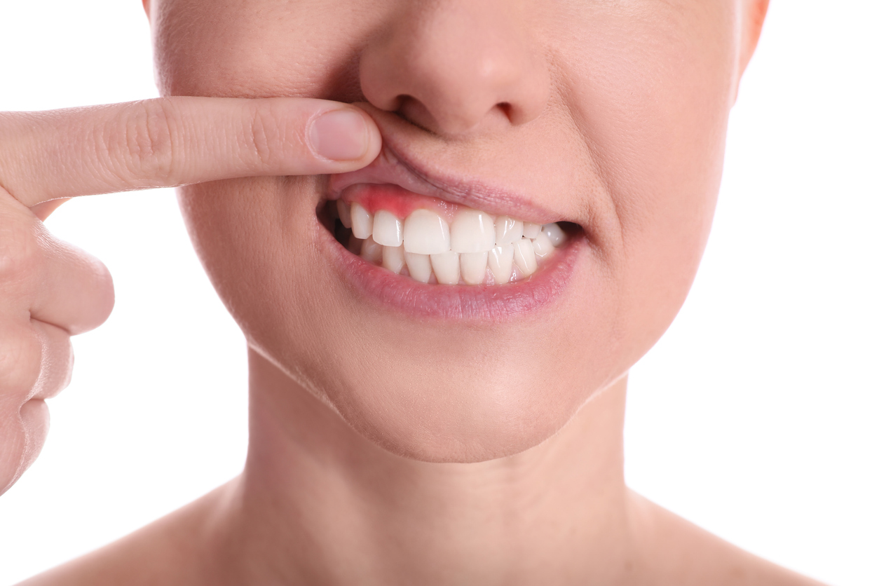 Featured image for 5 Common Myths About Gum Disease