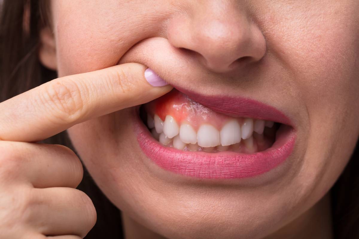 Featured image for What Are the Signs of Periodontal Disease?