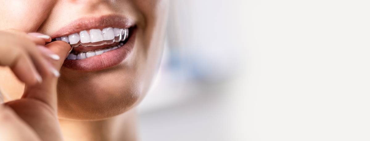 Featured image for How Does Invisalign Work?